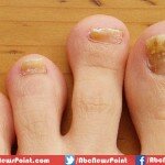 Fingernail Tells You about Your Overall Health
