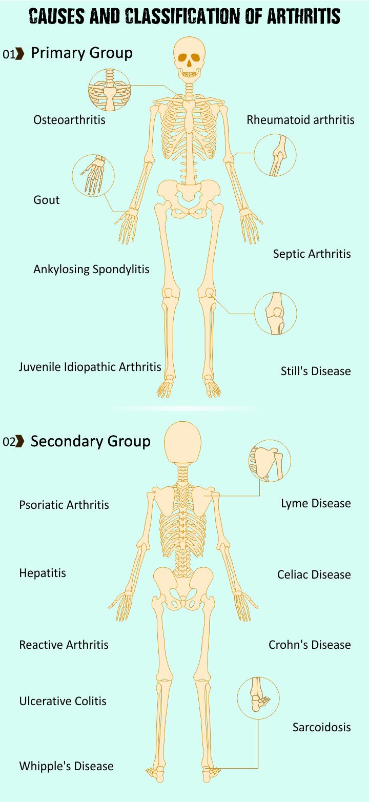 Arthritis